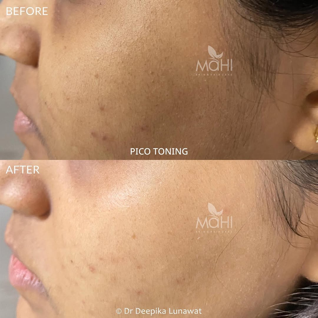 PICO laser toning before after cheek pigmentation Chennai
