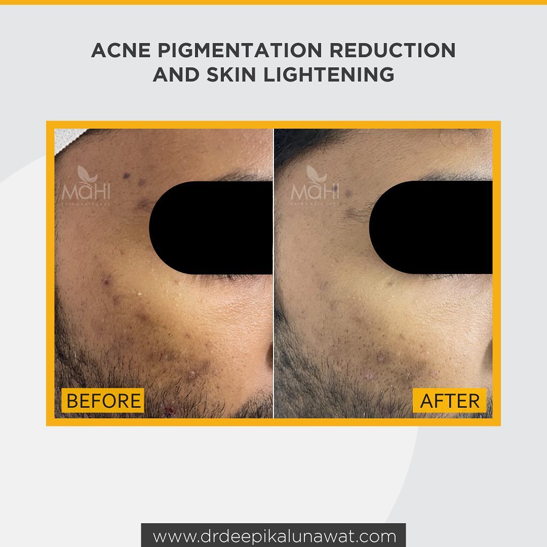 Post acne pigmentation treatment before after male Chennai — Mahi
